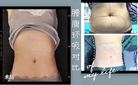 臨沂瑞麗整形醫(yī)院腰腹環(huán)吸術(shù)后對比案例