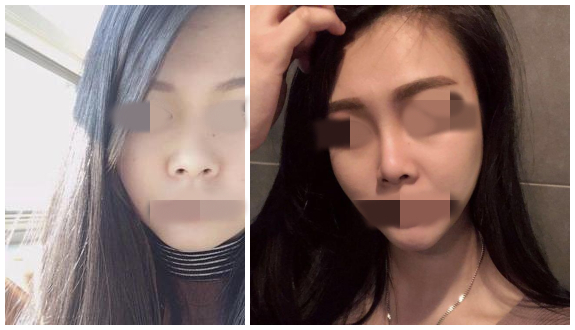 煙臺壹美天成整形醫(yī)院假體隆鼻案例