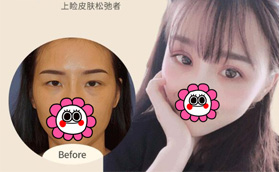 寧波壹加壹全切雙眼皮案例對比照