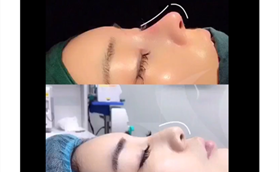 廊坊維恩肋軟骨隆鼻案例對比