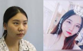 在洛陽孔繁榮醫(yī)療美容門診部進(jìn)行眼鼻綜合后華麗變身