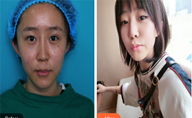 決定來(lái)北京做眼修復(fù)，看了麗星翼美案例圖和價(jià)格之后就做