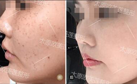 太原歐美蓮超皮秒祛斑前后對比案例