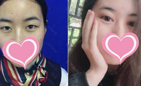 常州施爾美整形基礎眼綜合術(shù)前術(shù)后對比效果