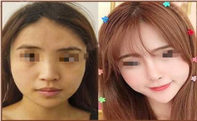 武漢壹加壹整形隆鼻手術(shù)案例分享