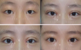 大同清木整形官網(wǎng)雙眼皮手術(shù)前后對比案例