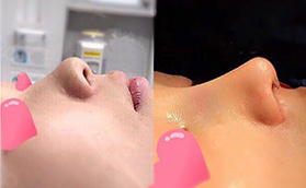 大慶彤銘醫(yī)療美容田程醫(yī)生鼻綜合案例