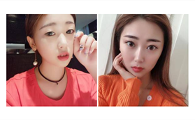 廊坊華康雙眼皮手術(shù)案例