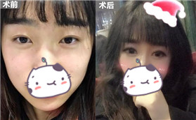 做完全切雙眼皮+開(kāi)內(nèi)眼角手術(shù)后，就是不一樣了