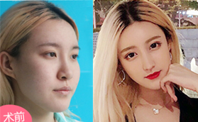 青島華顏美醫(yī)療美容醫(yī)院美人弧·原生翹鼻案例