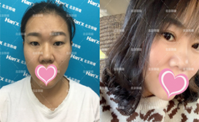 北京做雙眼皮哪家好？白永輝切開雙眼皮+開內(nèi)眥真人案例