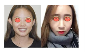 做了鼻綜合整形后，再也不擔(dān)心變回塌鼻子了