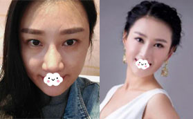 恢復后才知道深圳希思整形醫(yī)院為何給我選擇鼻綜合隆鼻！