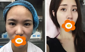 鄭州天后孔慶頌為我做硅膠假體+耳軟骨隆鼻后,鼻子精致自然