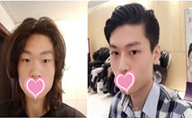 北京華韓余恩旭切開(kāi)雙眼皮+膨體隆鼻價(jià)格合理效果自然