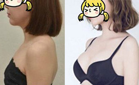 在海南瑞韓做的進口曼托假體隆胸手術(shù)，看看效果怎么樣