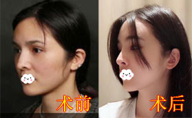 隆鼻失敗鼻梁歪斜沖深圳非凡梅夠明口碑找他做鼻綜合修復