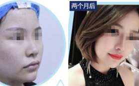 太原時(shí)光自體軟骨隆鼻對比案例
