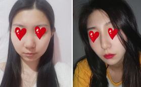 我還在上大學(xué)的時(shí)候攢錢(qián)去貴陽(yáng)美貝爾做的假體隆鼻手術(shù)