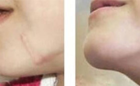 在海南東湖整形做RDL深層再生祛疤術(shù)之祛疤，案例對(duì)比明顯