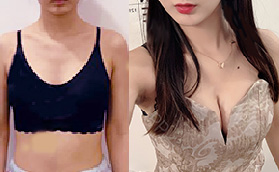 胸小不敢穿吊帶，羨慕胸大的女生，假體隆胸我來了！