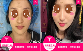 趁著價格優(yōu)惠我去北京潤美玉之光做超皮秒激光祛斑手術(shù)