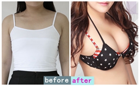 沈陽百嘉麗李衍江黃金定制動感美胸案例