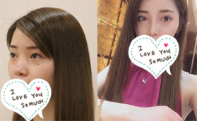 硅膠隆鼻1個月恢復(fù)效果讓你了解蚌埠華美章華做鼻子好嗎?