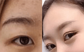 ?？诩t妝尚劉志坤醫(yī)生芭比眼綜合手術(shù)的優(yōu)勢(shì)以及案例分享