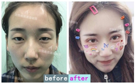 沈陽名流自體脂肪全臉填充+經典全切雙眼皮案例