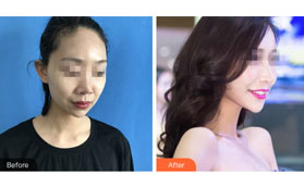 從我做假體隆鼻術(shù)后恢復(fù)圖來看硅膠和膨體哪個好