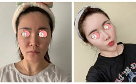 哈爾濱雅美自體脂肪填充面部前后效果對比