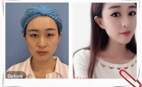 南京美貝爾整形醫(yī)院黃名斗醫(yī)生切開(kāi)雙眼皮手術(shù)案例