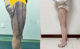 成都艾米麗整形醫(yī)院吸脂前后對比圖