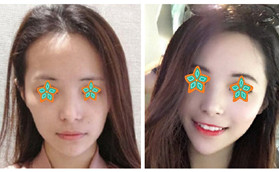 在哈爾濱諾依美做自體脂肪填充面部3個月后給出恢復(fù)照片