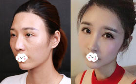 大方承認(rèn)我的肋軟骨隆鼻是找深圳美萊梁曉健院長(zhǎng)做的