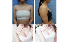 FDA+CE雙重認證的傲諾拉閃耀假體，這手感10萬的價格也認了