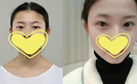 腫眼泡割雙眼皮后真丑?我找重慶華美陳凱割雙眼皮自然好看