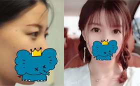 桂林哪里割雙眼皮比較好?桂林時(shí)光張華峰雙眼皮必須上榜