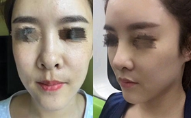 唐山蘇亞美聯(lián)臣口腔美容中心露鼻孔矯正案例