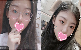 北京米蘭柏羽麗都曹衛(wèi)華做雙眼皮效果怎么樣？埋線雙眼皮真人案例