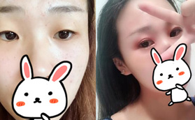 做雙眼皮一定要開眼角嗎？反正我到常州美貝爾面診是做了