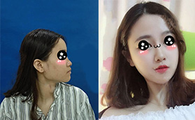 親測在廈門華美做人造支架隆鼻后比朋友的硅膠隆鼻效果好