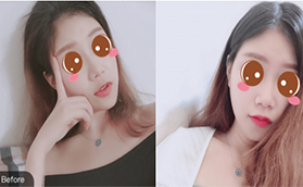 北京豐唇哪家好？記錄在北京葉子玻尿酸豐唇十天恢復(fù)情況