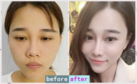 沈陽藍(lán)天醫(yī)療美容醫(yī)院黃瑞興八度藝術(shù)美鼻案例