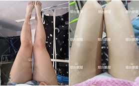 煙臺(tái)鵬愛整形醫(yī)院大腿吸脂前后對比案例
