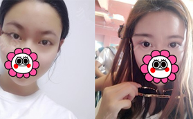 ?想看劉晉元割雙眼皮真人案例可以看我手術(shù)20天恢復(fù)過(guò)程圖