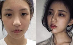 找蘭州皙妍麗醫(yī)療馬振峰醫(yī)生做完鼻部多項后顏值飆升！