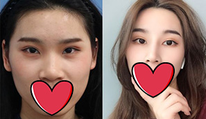 杭州格萊美半肋軟骨鼻綜合案例