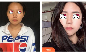 全臉脂肪填充失敗圖片還真沒有 變美的照片我倒是有不少